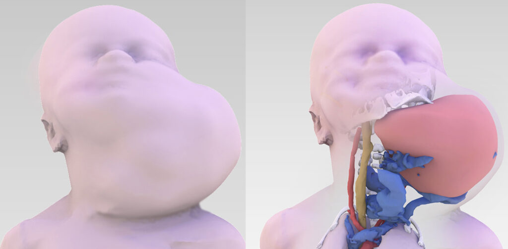 tumore alla gola neonato